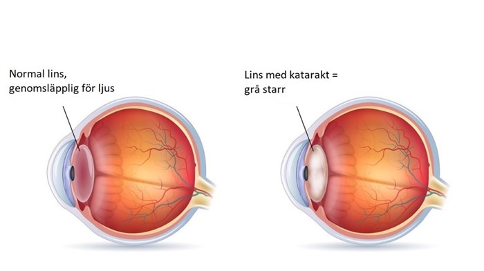 Lins med och utan katarakt